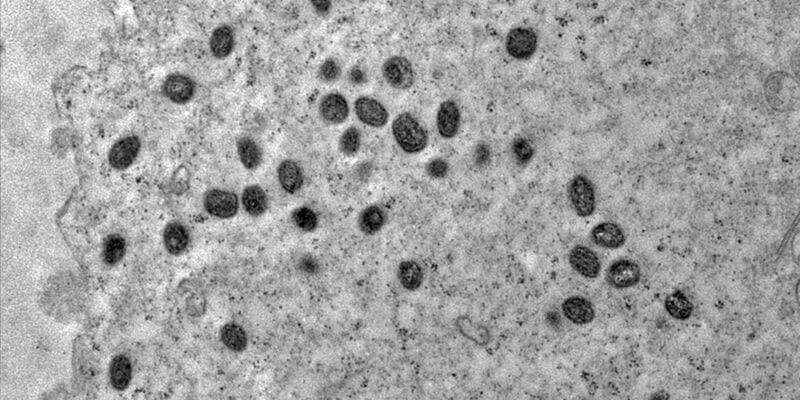 Pesquisa indica risco de monkeypox agravar infeccão por HIV