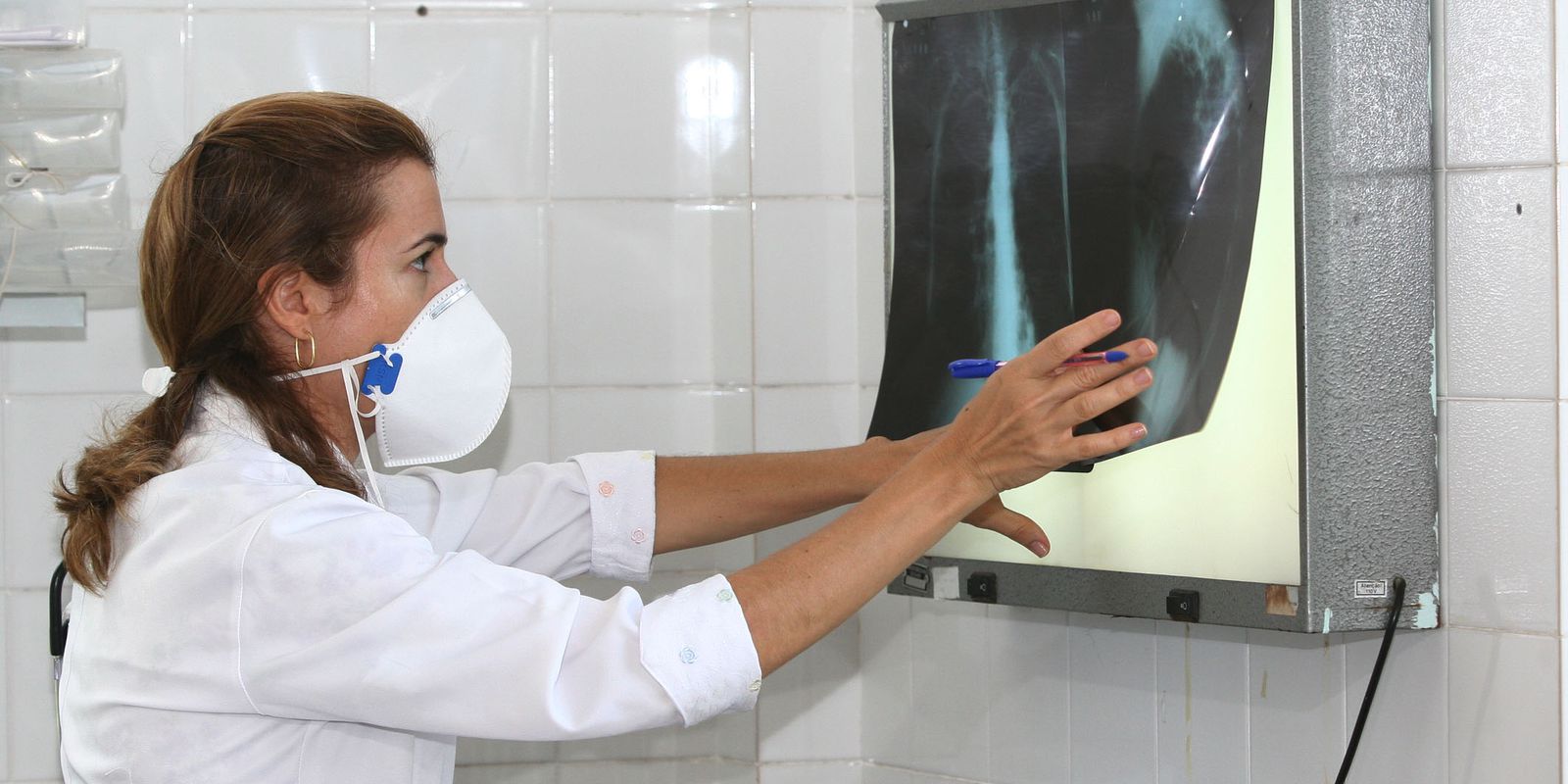 Brasil registra 78 mil novos casos de tuberculose em 2022