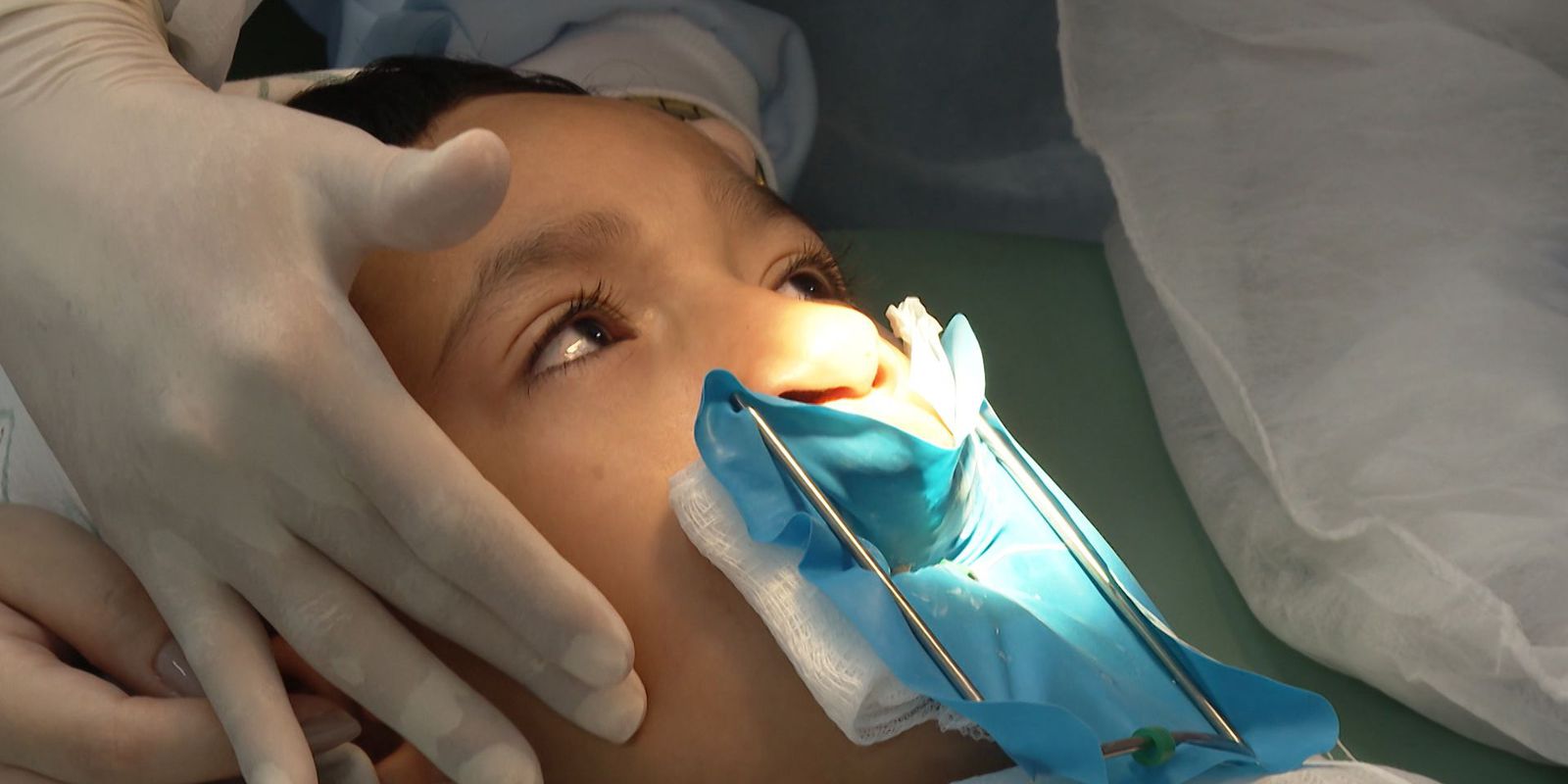 Genética e inflamação na gravidez explicam lábio leporino