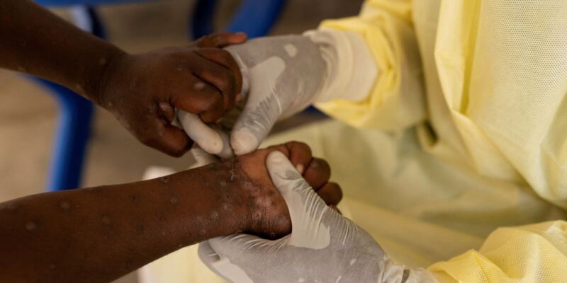 CFM orienta médicos para o monitoramento da mpox no Brasil